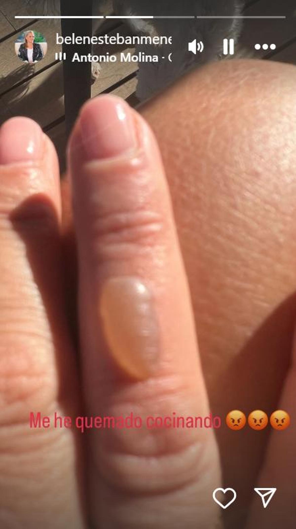 La ampolla del dedo de Belén Esteban
