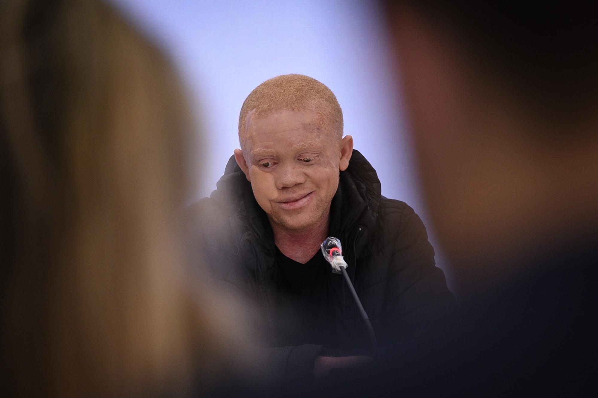 El guineano Reginaldo Carlos Mguema, un joven albino que ha sido intervenido por la Fundación de Pedro Cavadas de un extenso cáncer de piel en la cara, ha destacado ante los medios en Valencia: &quot;He recuperado la vida que pensé que había perdido&quot;.