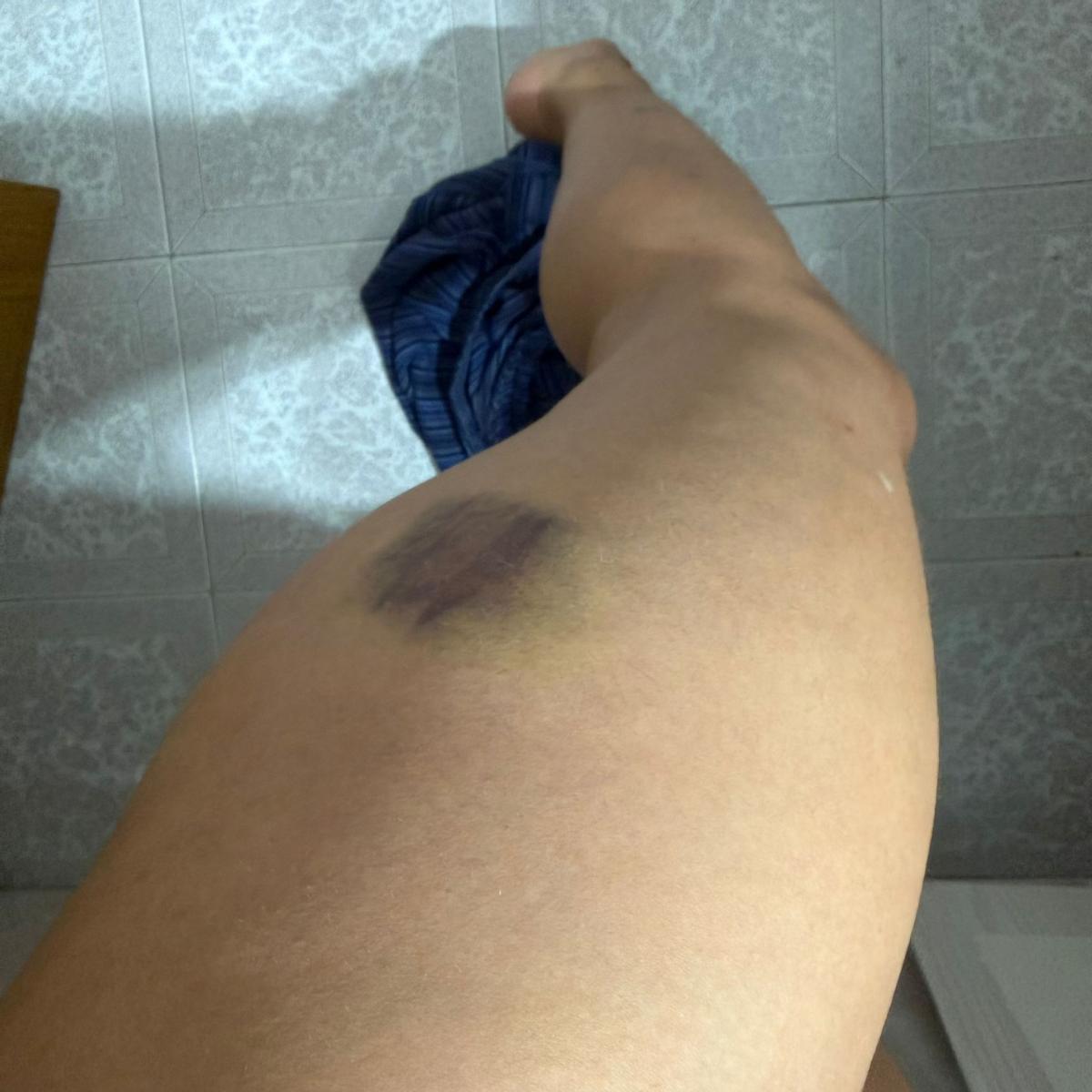 Detalle de un hematoma en el muslo de la víctima, días después de la liberación.