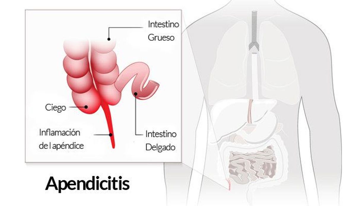 Diez síntomas para reconocer un ataque de apendicitis