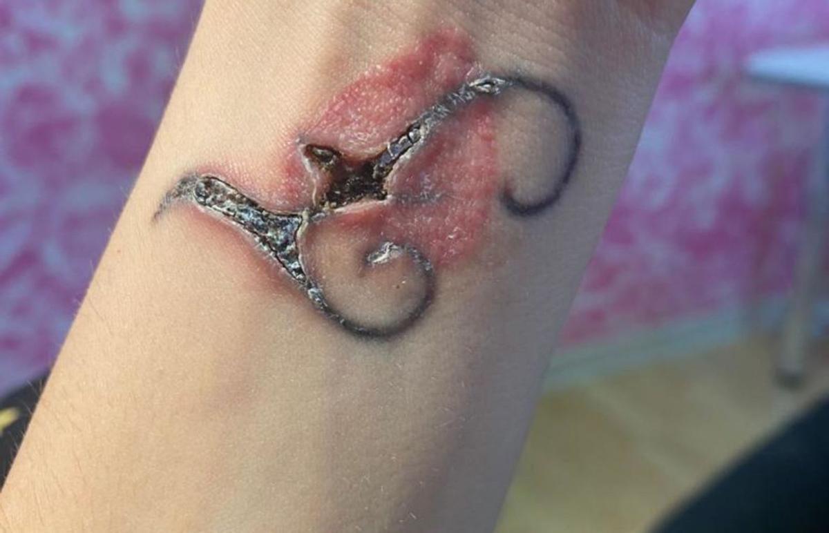 Quemadura realizada por alguien sin los conocimientos adecuados para eliminar un tatuaje. | DI