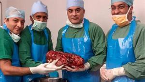 Los médicos con el riñón extirpado, de más de 7 kilos