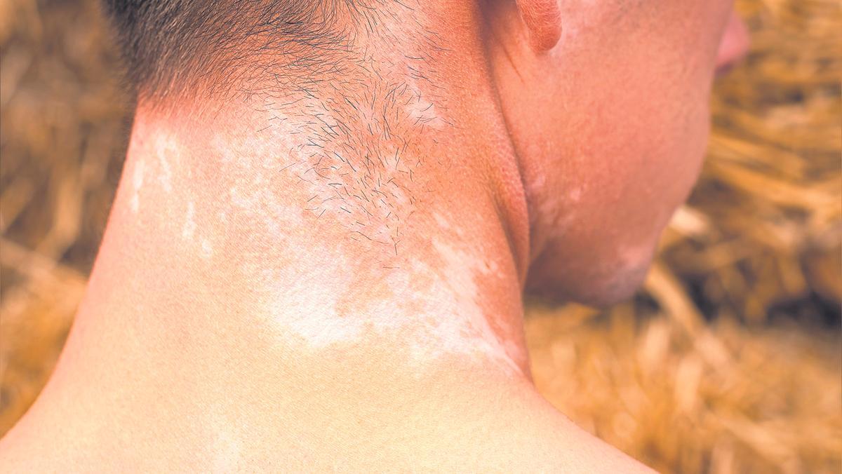 Els millors tractaments per eliminar les taques de la pell