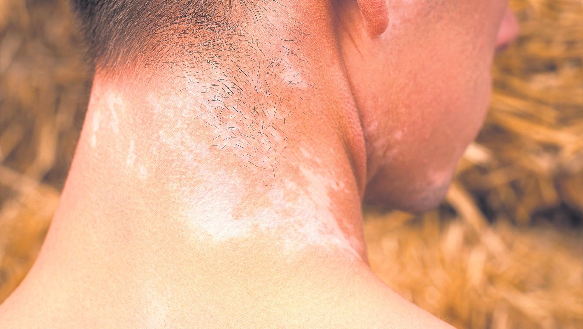Las manchas en la piel son el resultado de la diferente alteración de la melanina y las células que la producen, los melanocitos