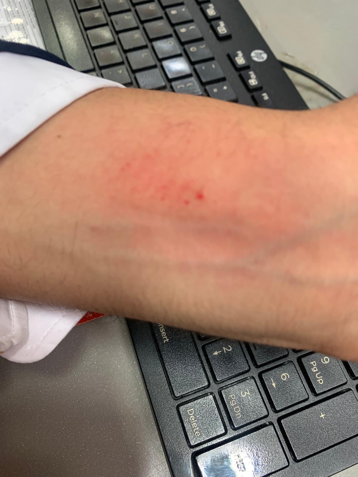 Un empleado muestra la última picadura de chinche en su brazo