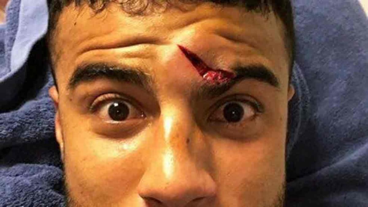 Rafinha se rompió la nariz