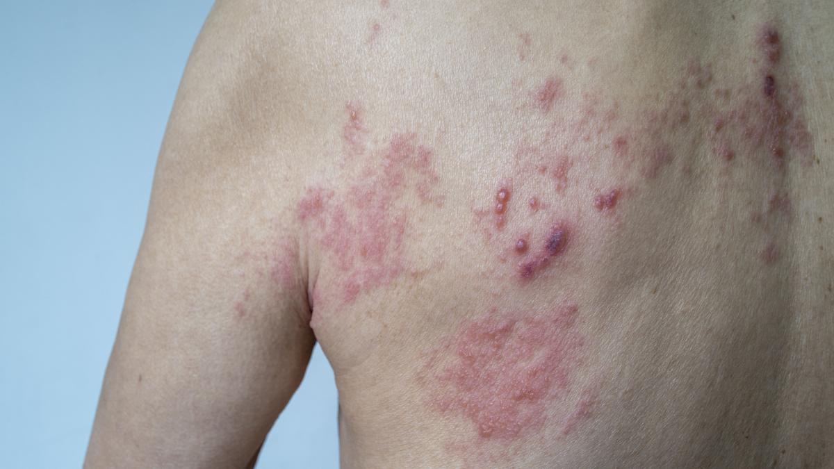 El herpes zóster afecta a 1 de cada 3 personas de entre 50 y 90 años