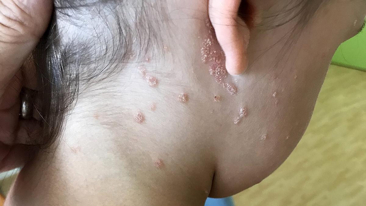 Psoriasis en una niña de 9 años