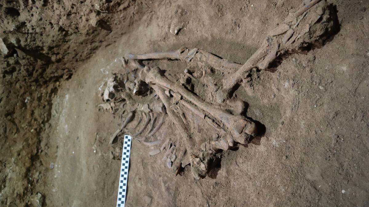 La primera amputación quirúrgica se habría realizado hace 31.000 años.