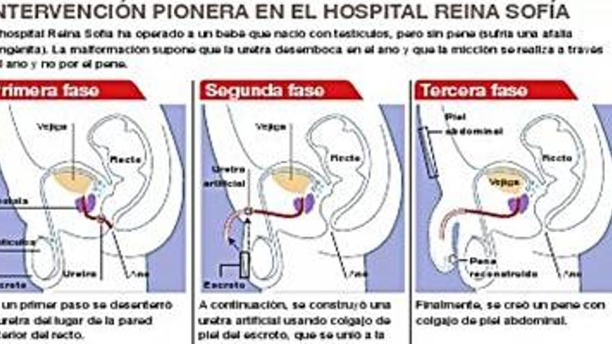 El Reina Sofía realiza una uretra y un pene a un bebé que nació sin el órgano