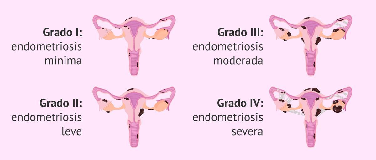 ¿Cuáles son los grados de endometriosis?