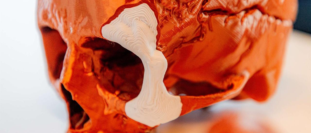 Implantes óseos impresos en 3D de la empresa Ossiform.