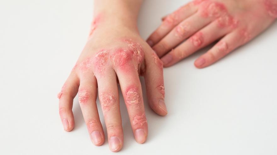 Esperanza para los pacientes con artritis psoriásica: BMS demuestra la eficacia de su fármaco oral