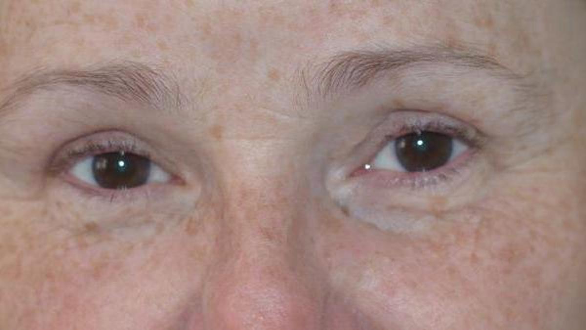 Resultado natural de una paciente tras realizarse una blefaroplastia con el doctor Moltó.