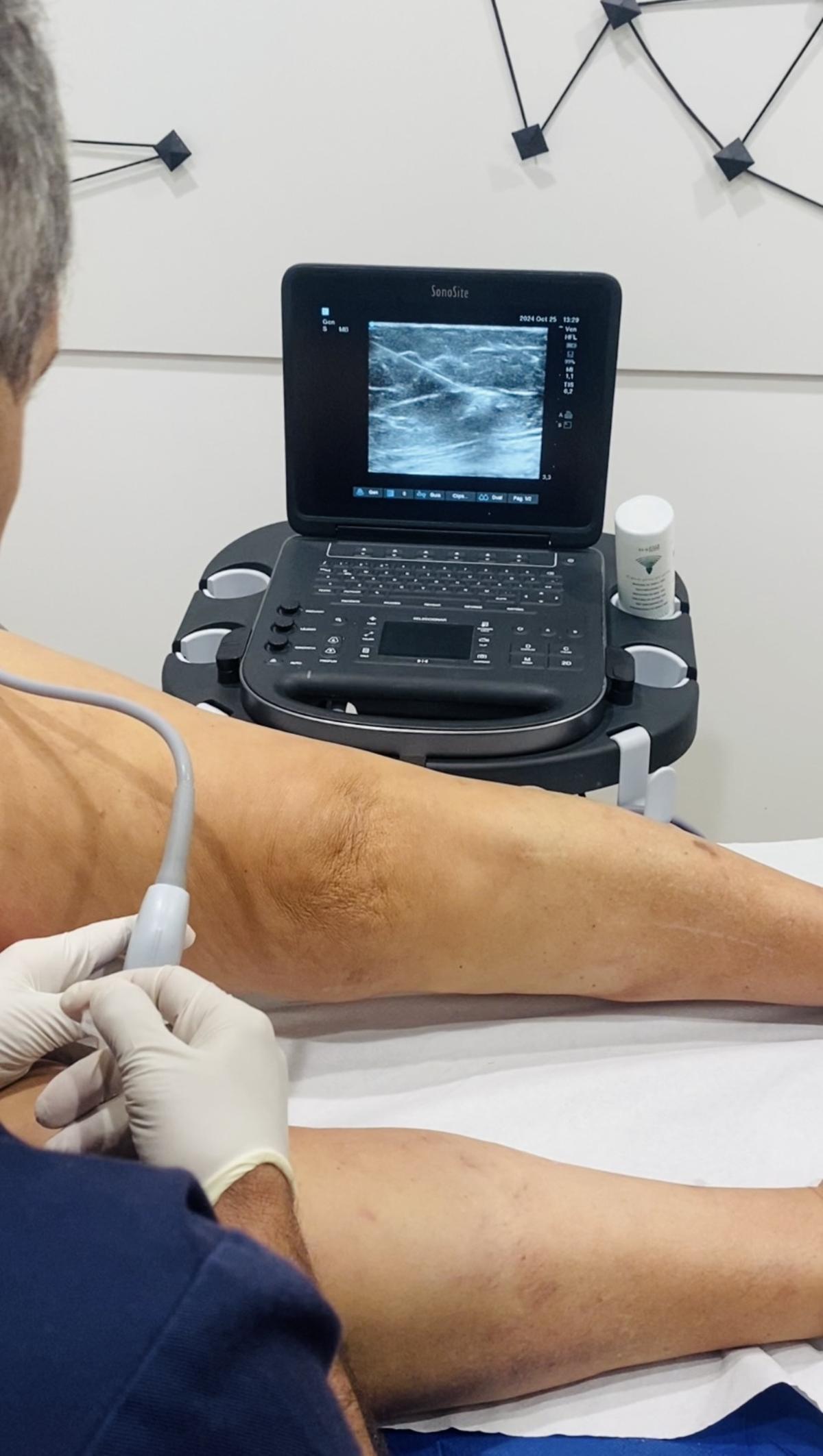 Tratamiento varices sin cirugía ecoguiado.