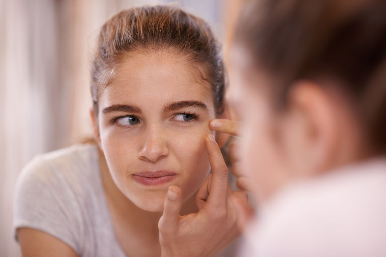 Si la piel tiene tendencia acneica, prevenir es clave