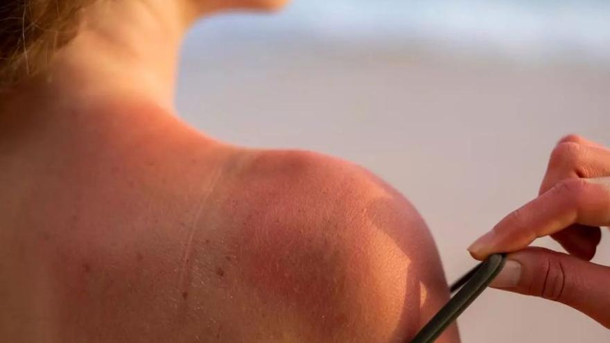 Una mujer muestra el hombro con quemaduras provocadas por la exposición al sol. | L. O.