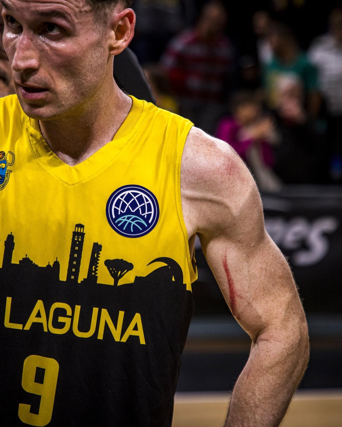 Así quedó el brazo izquierdo de Marcelinho Huertas.