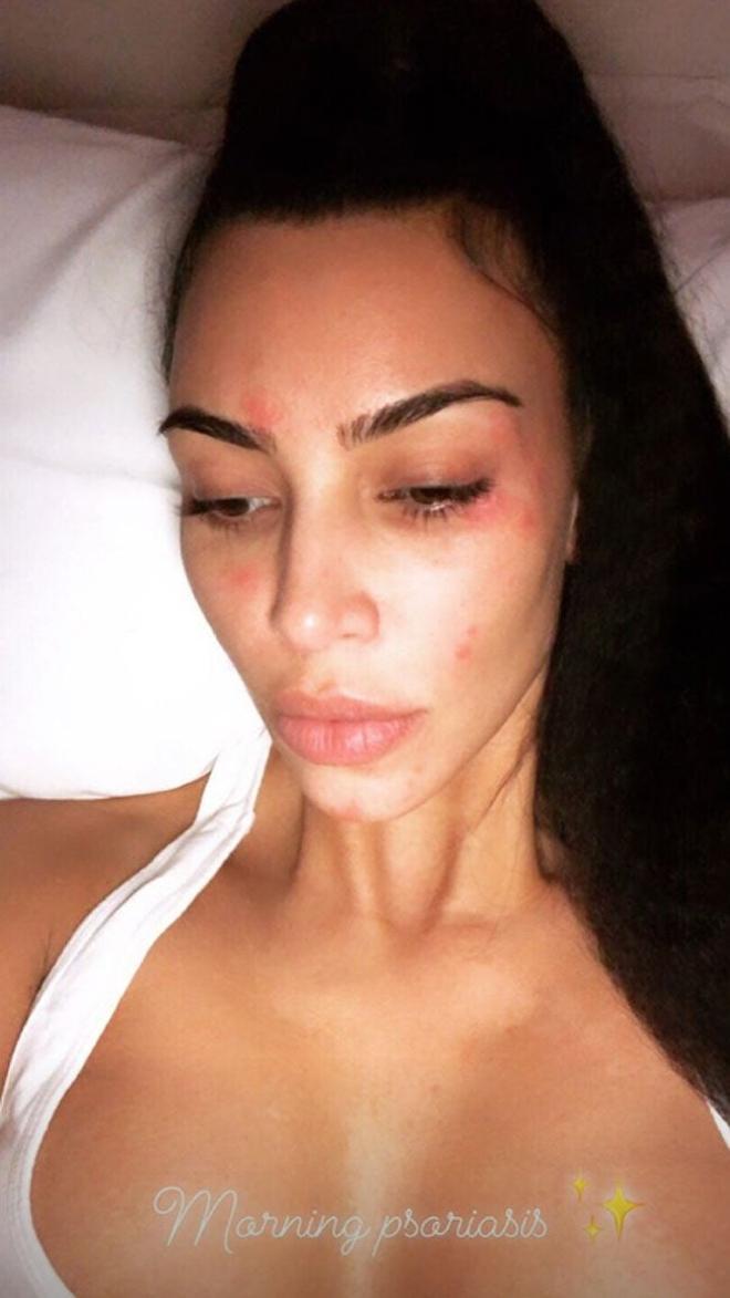 Kim Kardashian, muestra su psoriasis en la cara