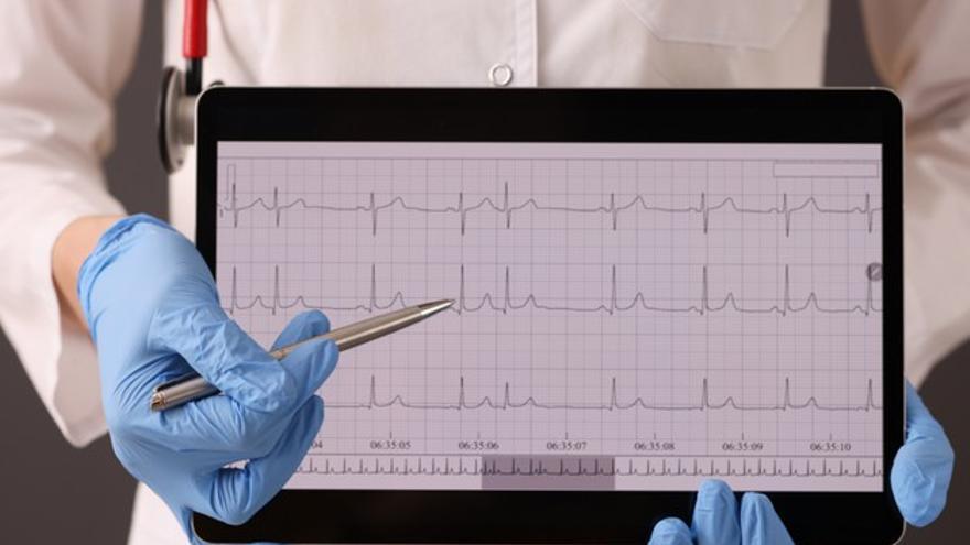 La cardiopatía isquémica es la enfermedad ocasionada por la arterosclerosis de las arterias coronarias.