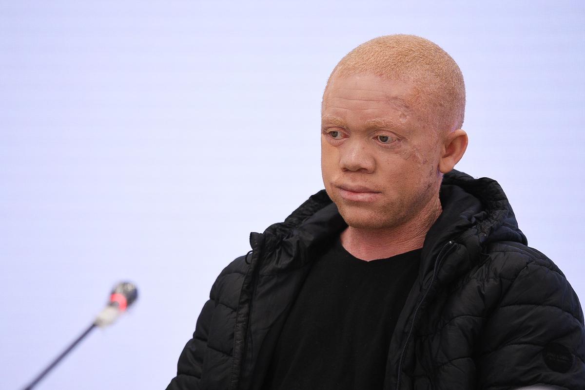 Cavadas reconstruye la cara a un paciente albino