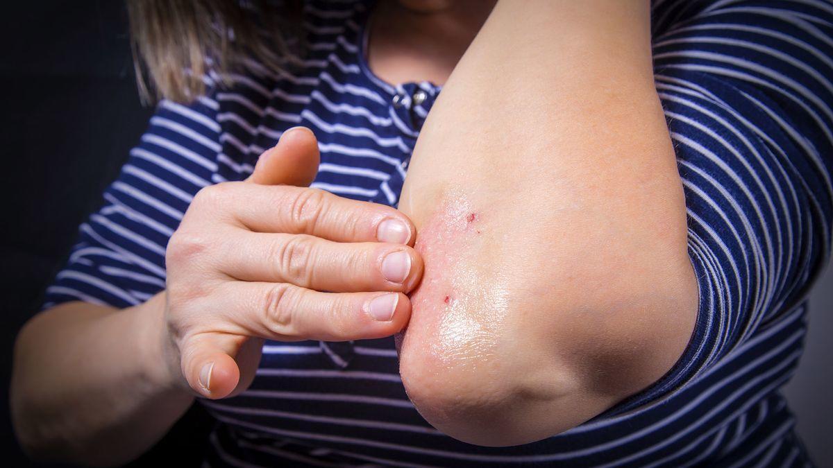 La psoriasis y el riesgo de que afecte a las articulaciones