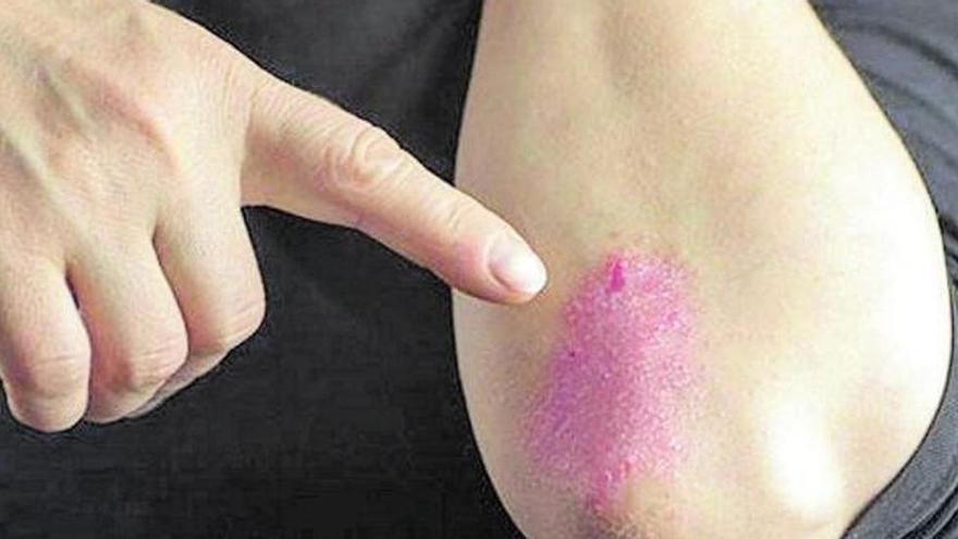 La pitiriasis rosada no se debe confundir con la psoriasis, que afecta al 2,3% de la población española.