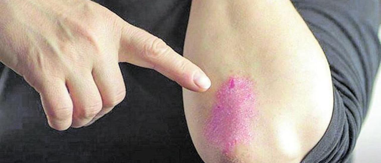 La psoriasis afecta al 2,3% de la población española.