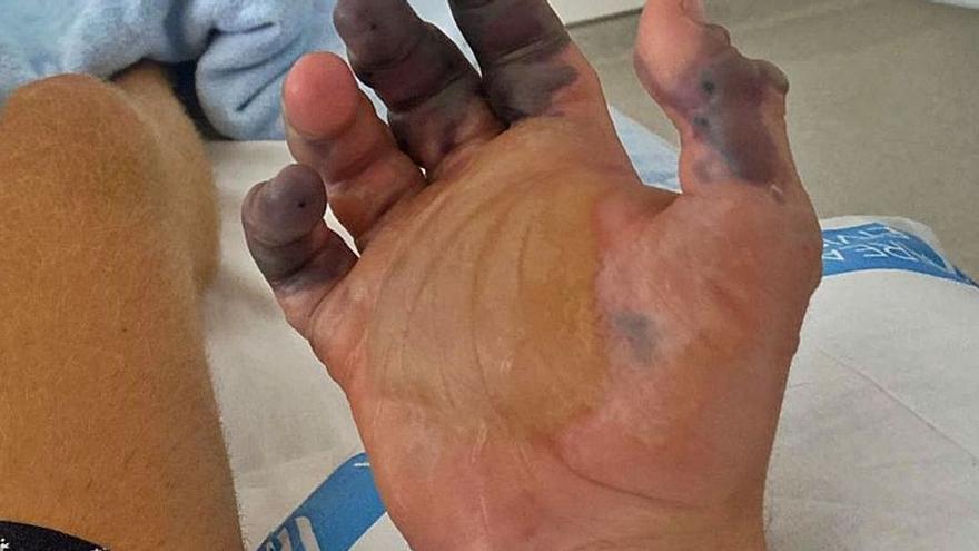 Un jove turista perd dos dits d&#039;una mà per la picada d&#039;una aranya a Eivissa