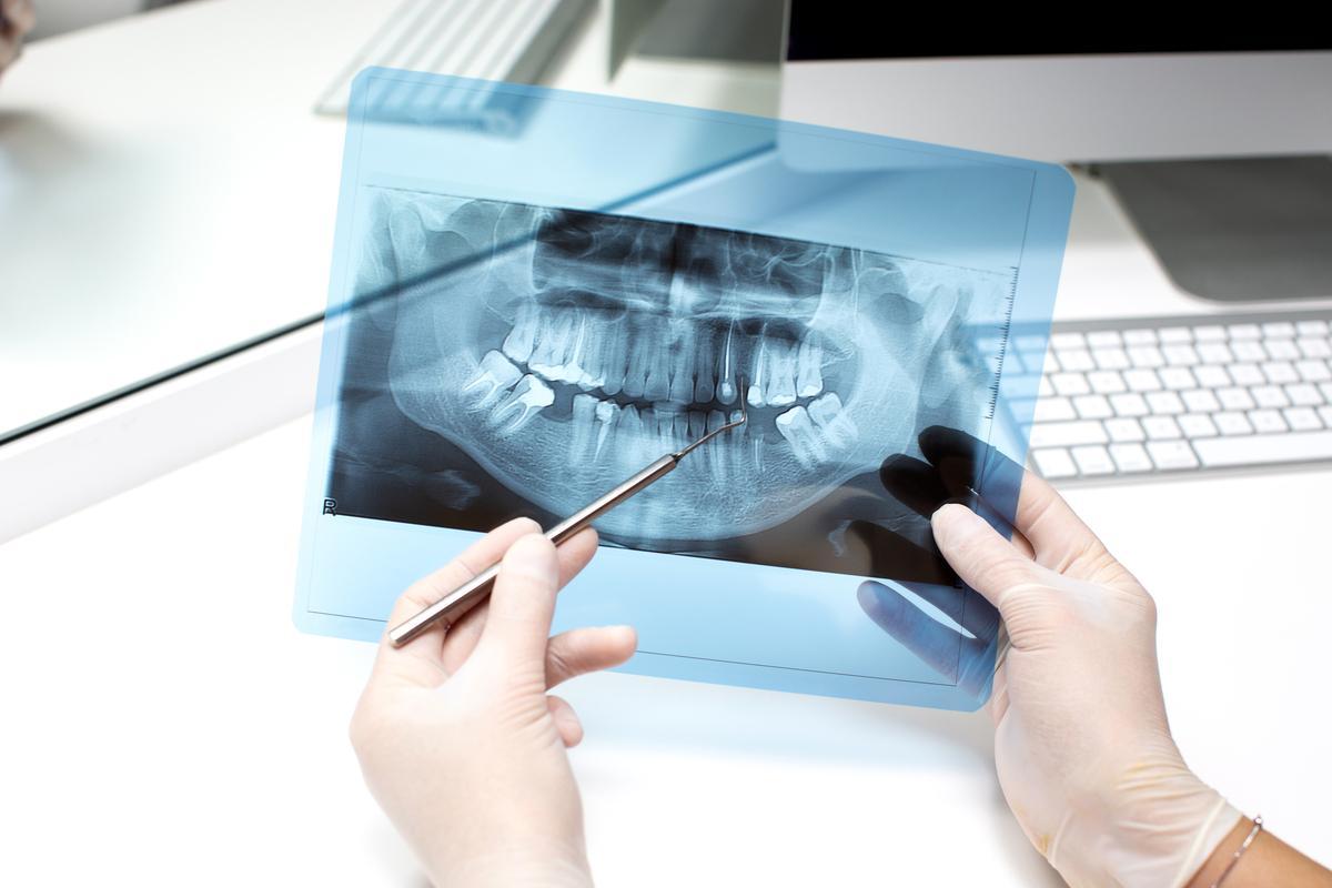 Antes de la extracción, el dentista o cirujano dental evaluará la posición y estado de las muelas del juicio mediante radiografías y examen clínico