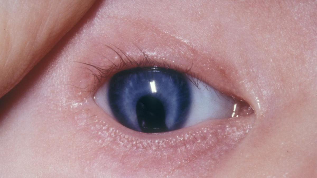 El coloboma es un defecto ocular desde el nacimiento