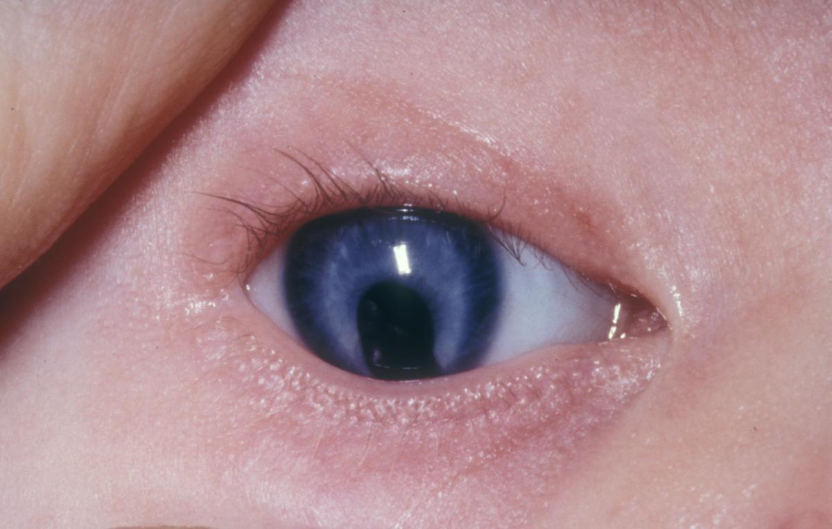 El coloboma es un defecto ocular desde el nacimiento