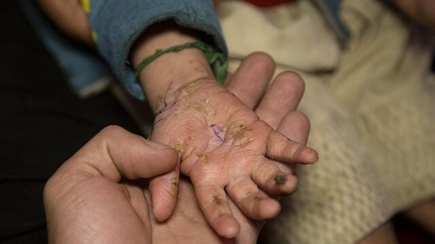 Piel de mariposa: así es unas de las enfermedades raras &quot;más dolorosas&quot;  y que ya afecta a más de 500 personas en España