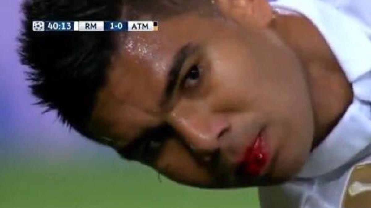 Casemiro acabó sangrando tras la acción de Godín