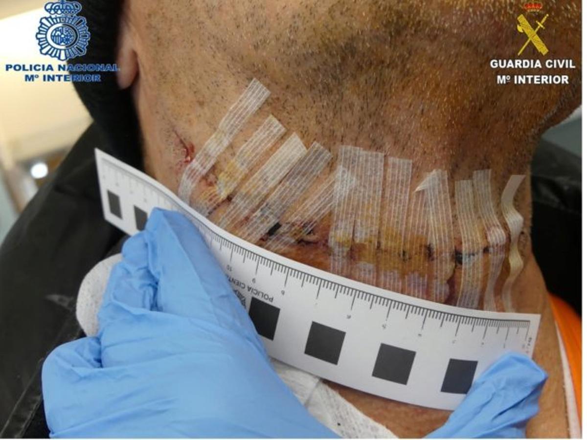 Imagen del corte que sufrió la víctima en el cuello