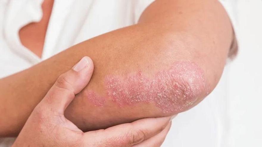 La psoriasi no té edat, la malaltia de la pell pot aparèixer també en les primeres etapes de vida