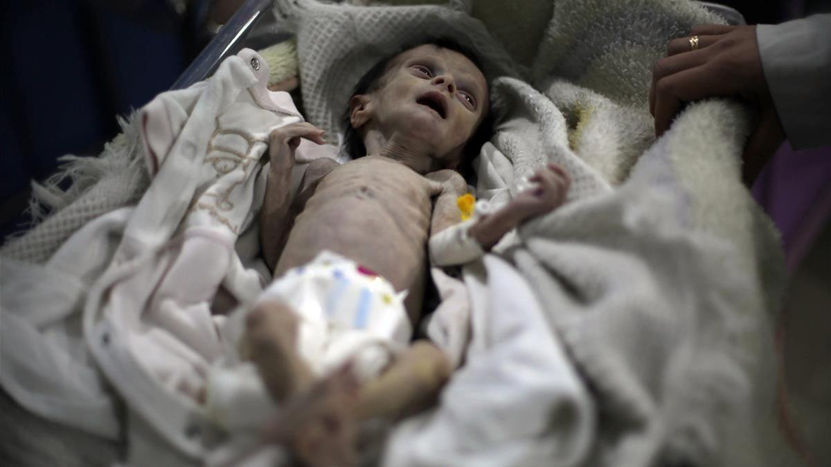 El pequeño Sahar Dofdaa desnutricion en Siria