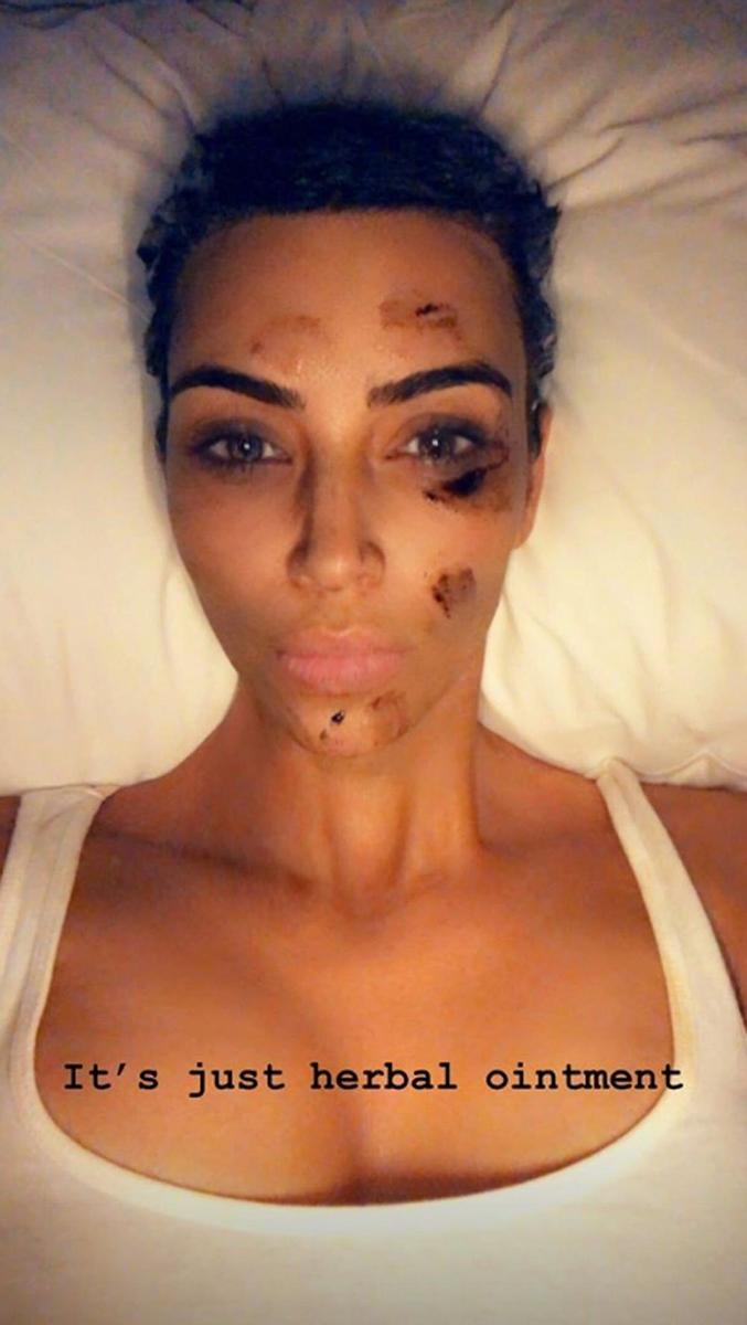 Kim Kardashian y su remedio casero para la psoriasis
