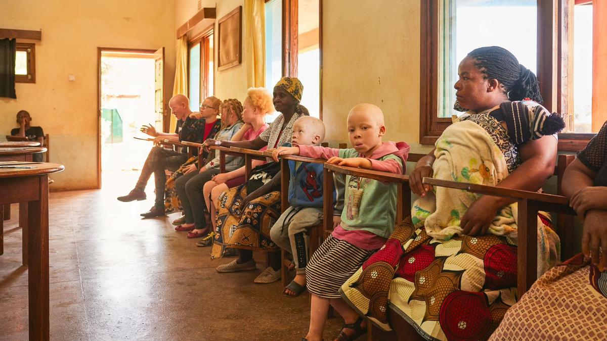 Los albinos de Mozambique son vulnerables al cáncer de piel, pero también al estigma social y la discriminación