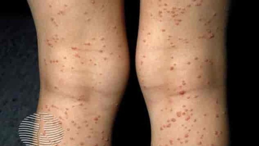 Moluscos en la piel: el virus silencioso que preocupa a pediatras y dermatólogos