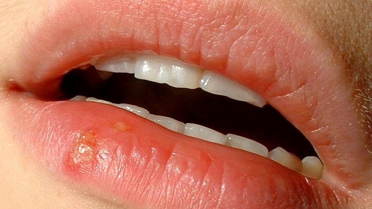 El herpes labial podría tener relación con el alzhéimer: el CSIC descubre que provoca alteraciones en modelos de neuronas