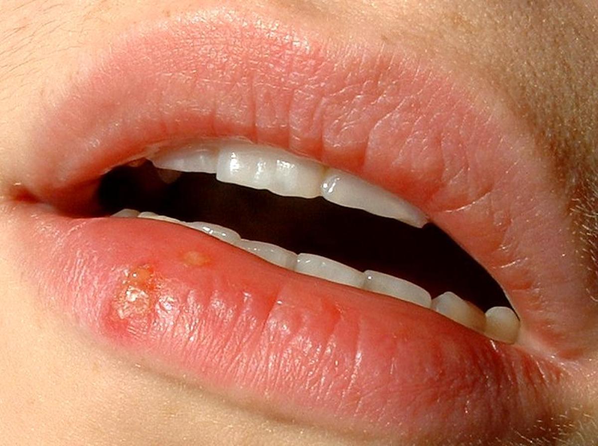 Herpes labial, una incómoda enfermedad bastante frecuente que no suele durar más de una semana
