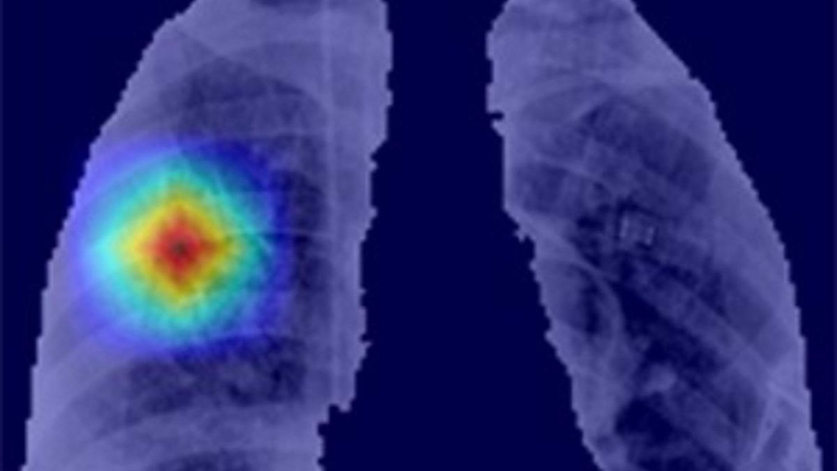 Resultados de segmentación automática de los pulmones