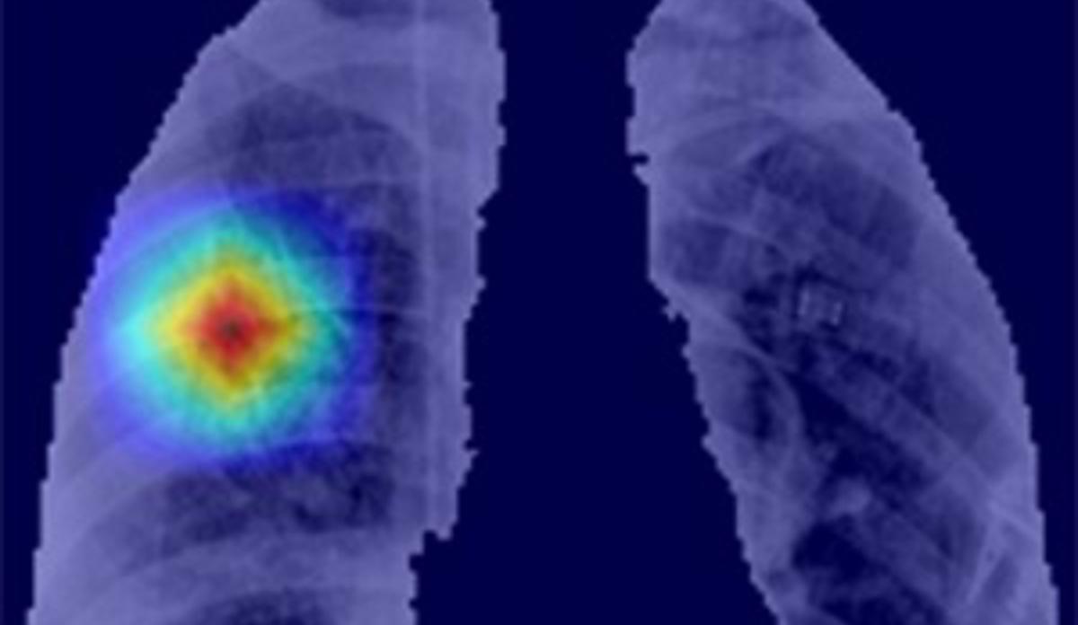Resultados de segmentación automática de los pulmones