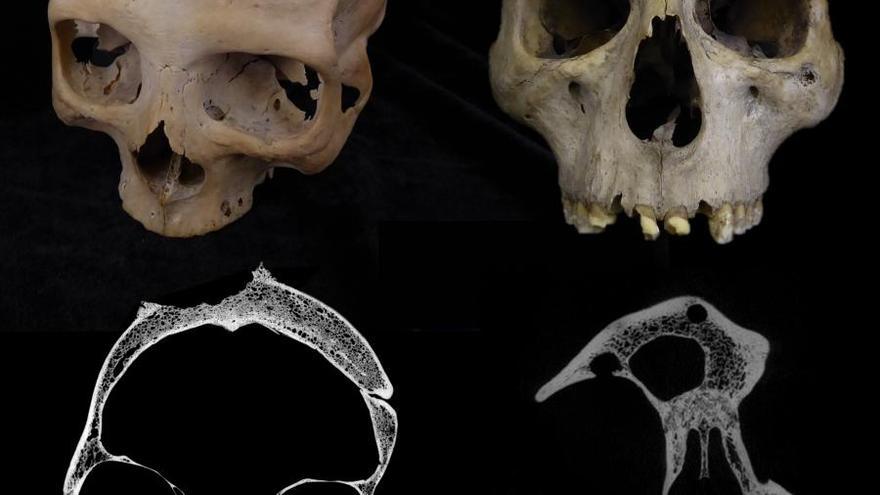 Un estudio liderado por la USC revela posibles intentos de tratar un cáncer en un cráneo egipcio de hace más de 4.000 años