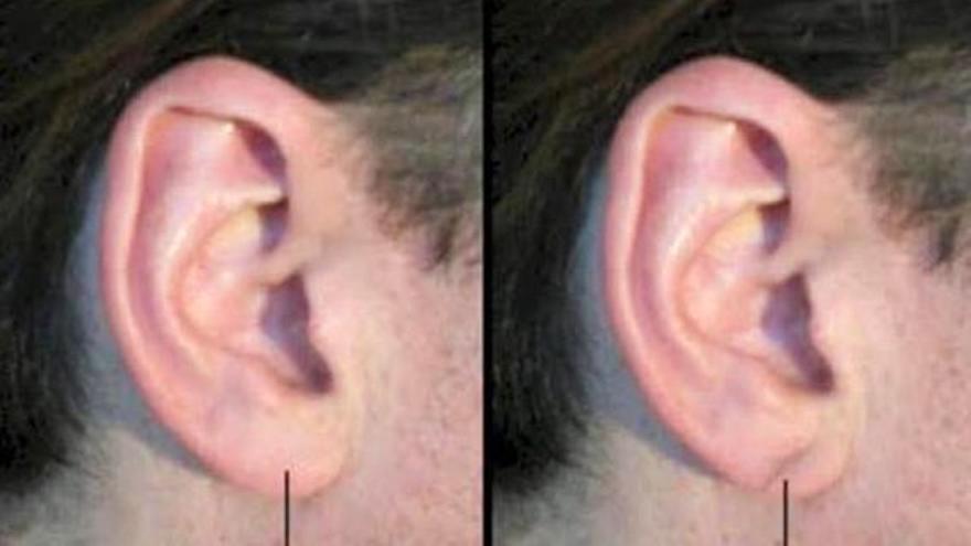 La advertencia de un cardiólogo: ten cuidado si observas que tienes este pliegue en la oreja