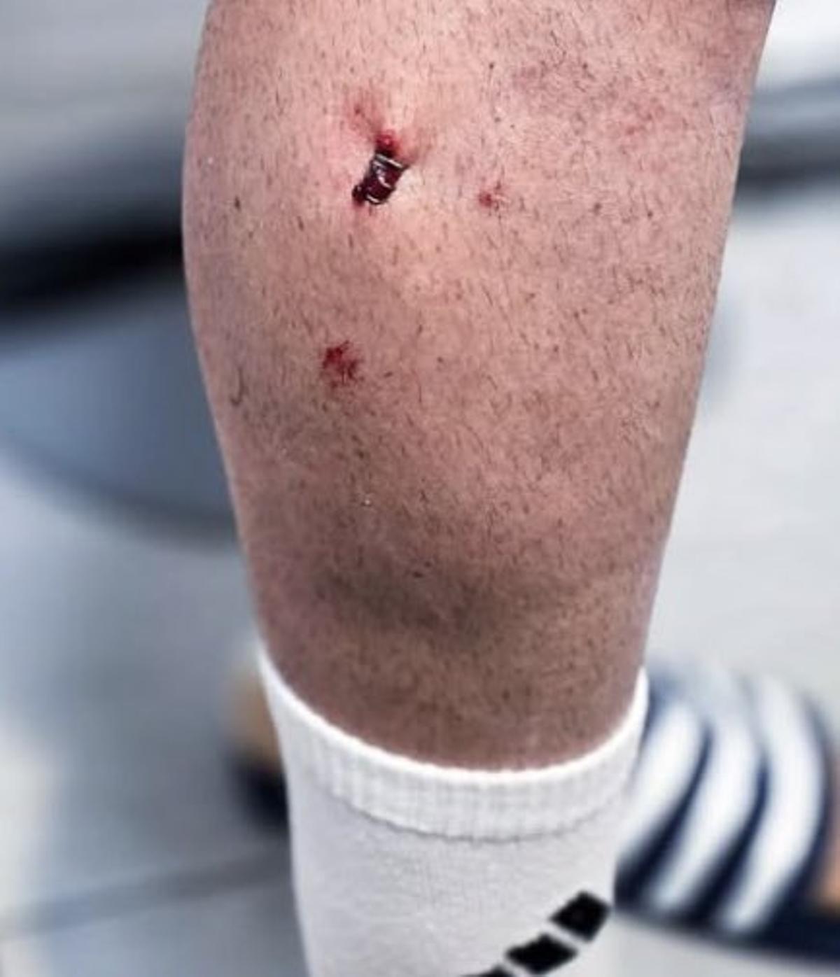 Las grapas en la pierna de Viñas