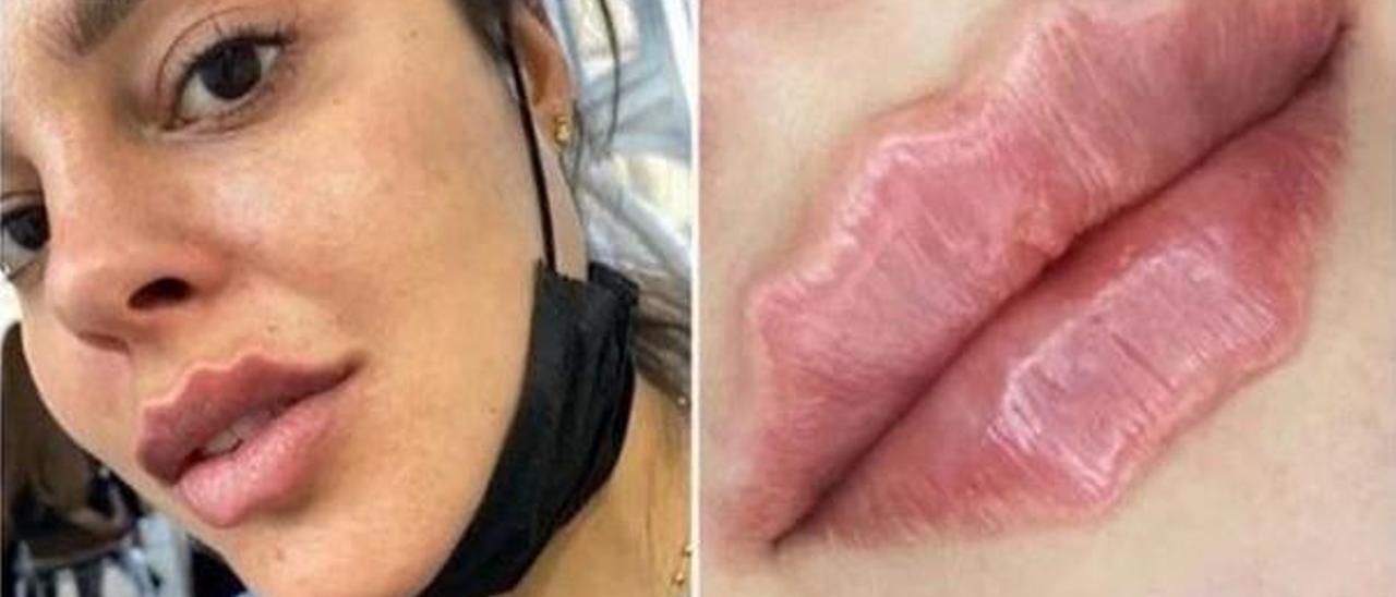 Los labios del diablo, los riesgos del último postureo de Instagram