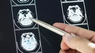 Día Internacional de los Tumores Cerebrales: ¿Qué síntomas nos avisan de su presencia?