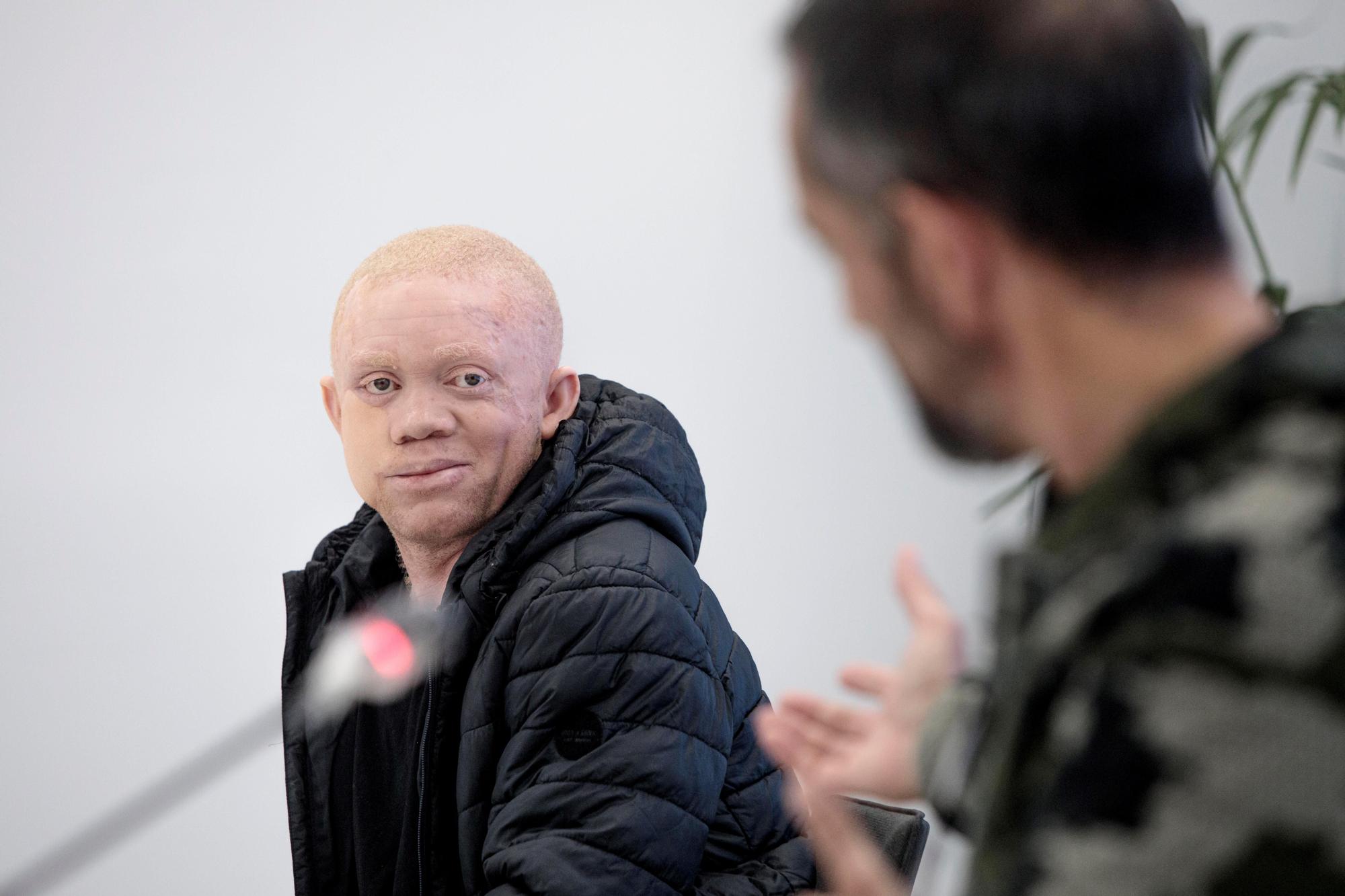 Cavadas reconstruye la cara a un paciente albino